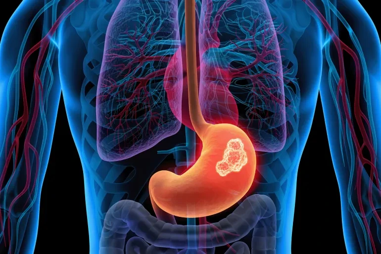 Large Study Reassures Heartburn Patients: No Link Found Between Acid Reflux Drugs and Stomach Cancer