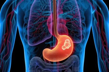 Large Study Reassures Heartburn Patients: No Link Found Between Acid Reflux Drugs and Stomach Cancer